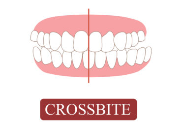 CROSSBITE