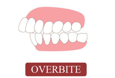 OVERBITE