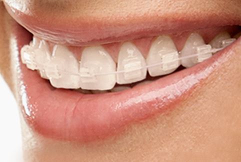 How-to-prevent-Discoloration-of-Ceramic-Braces