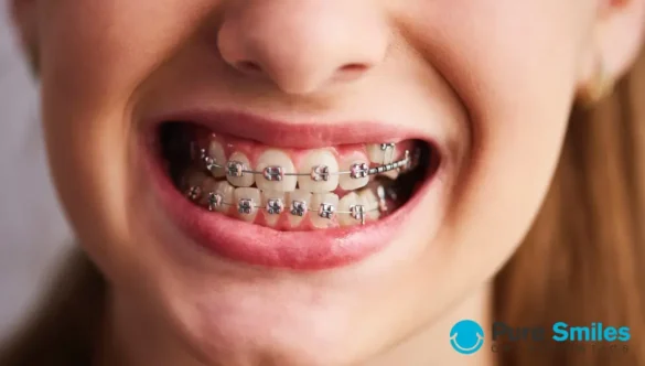 What Do I Need to Know About Getting Braces?