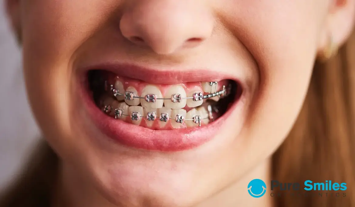 What Do I Need to Know About Getting Braces?