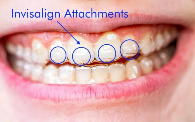 Invisalign-buttons-or-attachments-1024x565