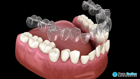 DEBUNKING COMMON MYTHS ABOUT INVISALIGN TREATMENT