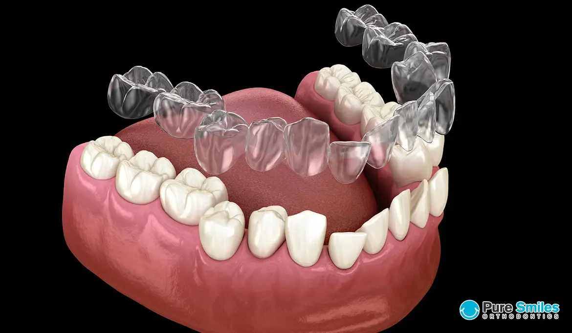 DEBUNKING COMMON MYTHS ABOUT INVISALIGN TREATMENT