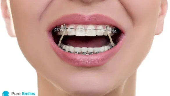 Why Are Orthodontic Elastics Important?