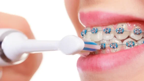 How Do I Remove Food from My Braces without Brushing?