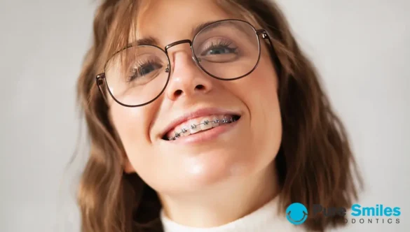 Exploring Your Braces Options in Adulthood