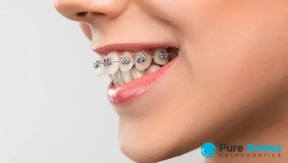Braces to Correct an Overbite Explained