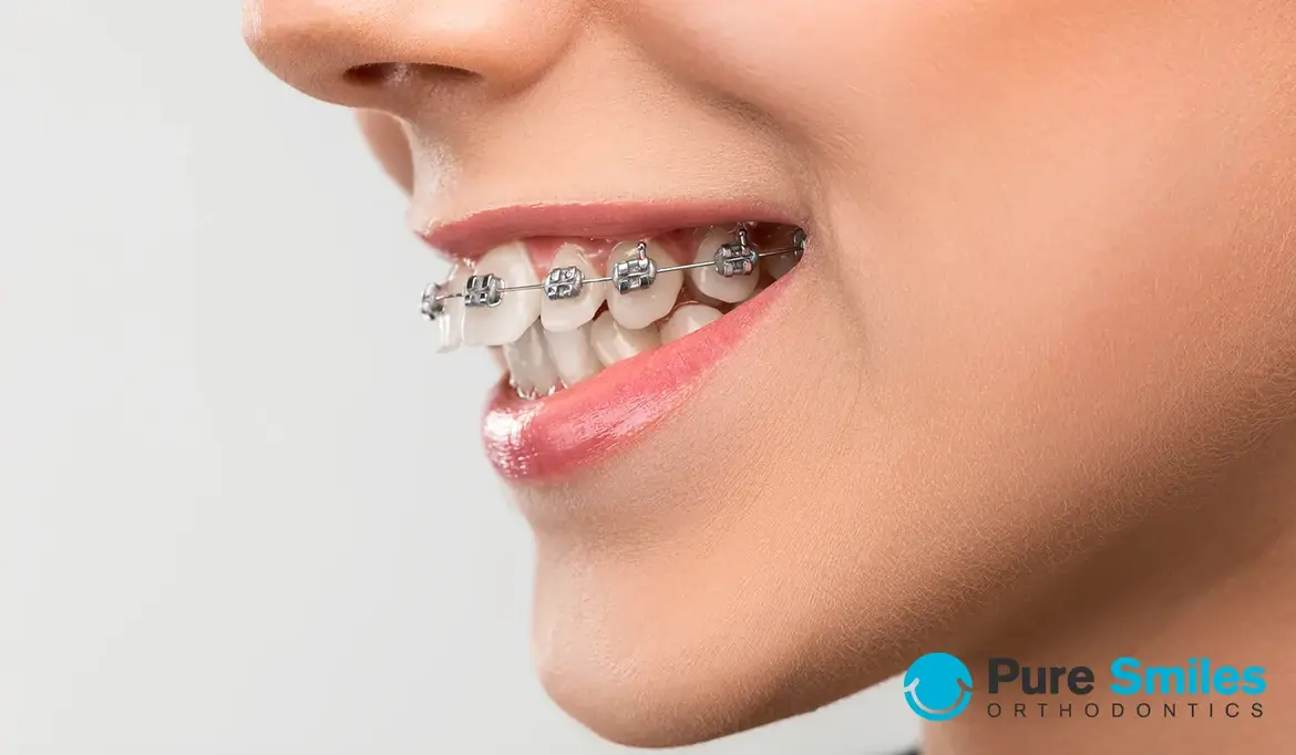Braces to Correct an Overbite Explained