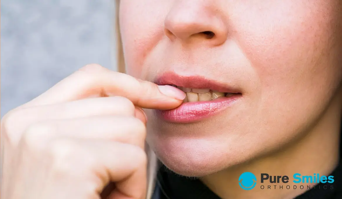 Can Braces Stain My Teeth?