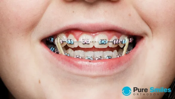 What Happens if I Don’t Wear My Elastics?