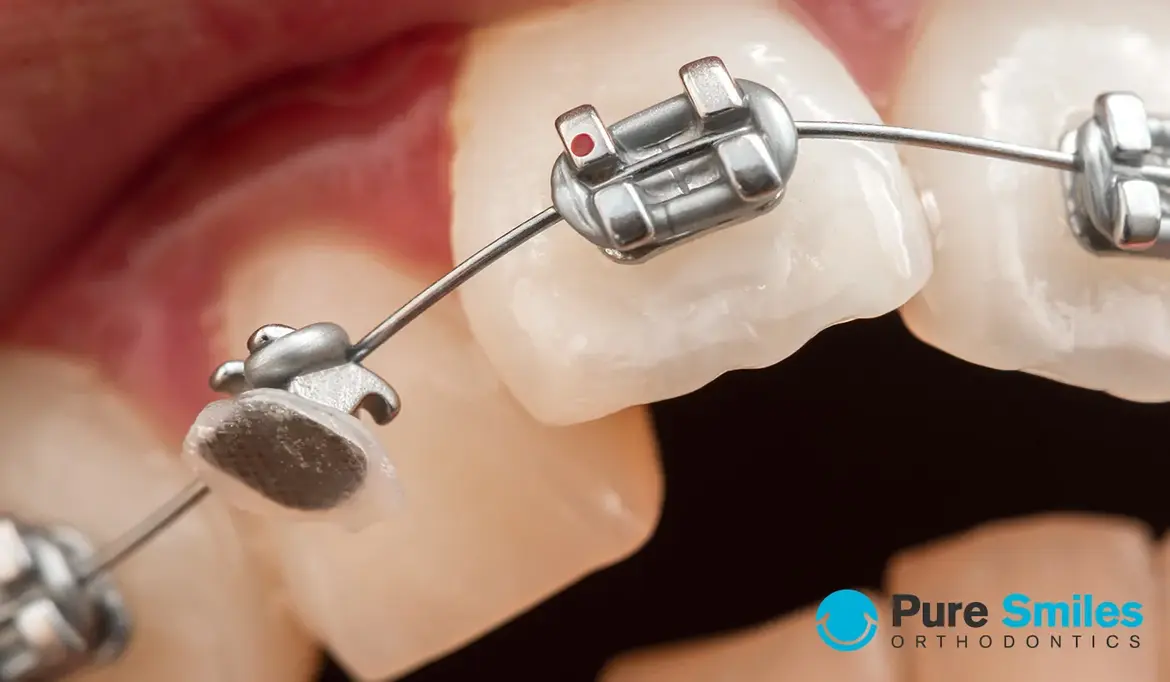 I Broke a Bracket – Now What?