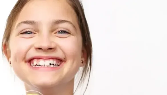 What Are Palatal Expanders?