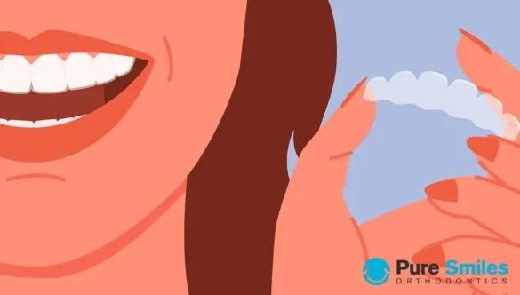 How Do I Clean My Aligners?