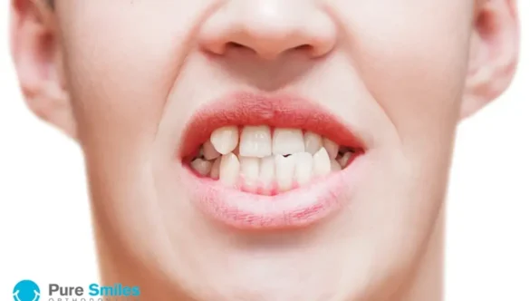 What Causes Crooked Teeth?