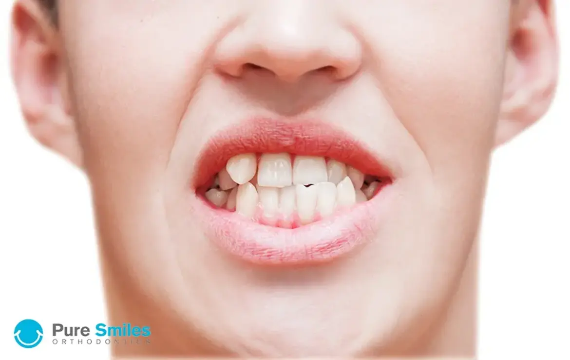 What Causes Crooked Teeth?