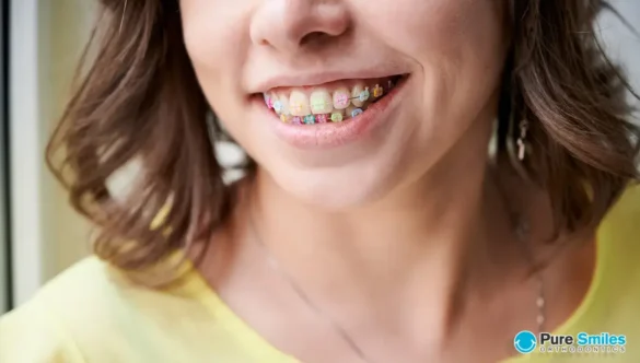 WILL BRACES STAIN MY TEETH?