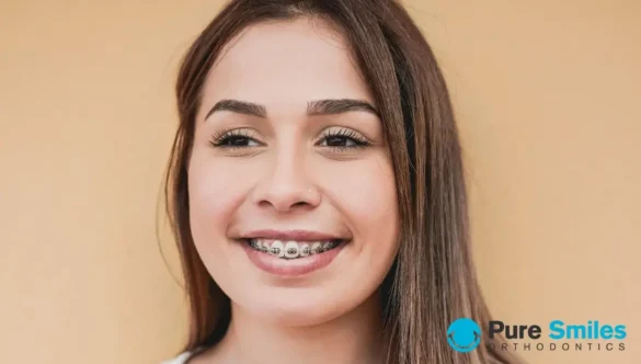 How Long Will I Be in Braces?