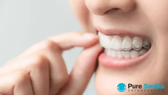 Help – I Haven’t Been Wearing My Aligners, Now What?