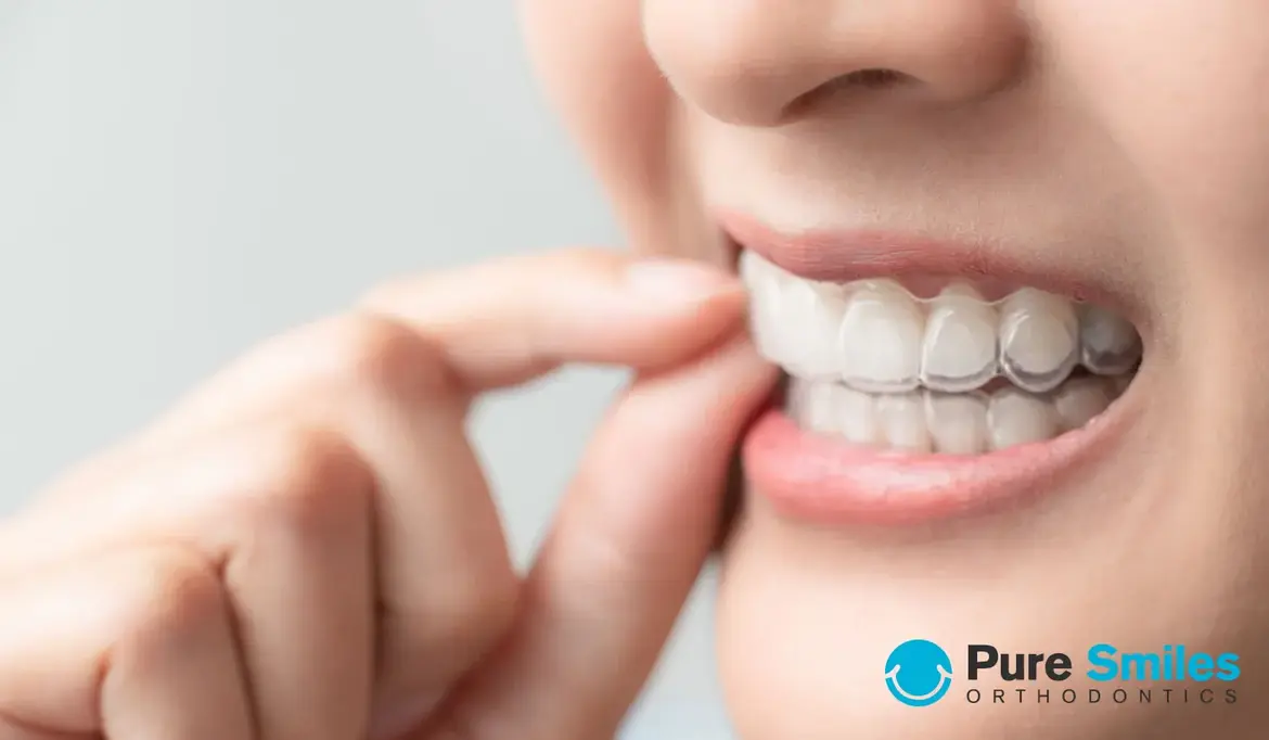 Help – I Haven’t Been Wearing My Aligners, Now What?