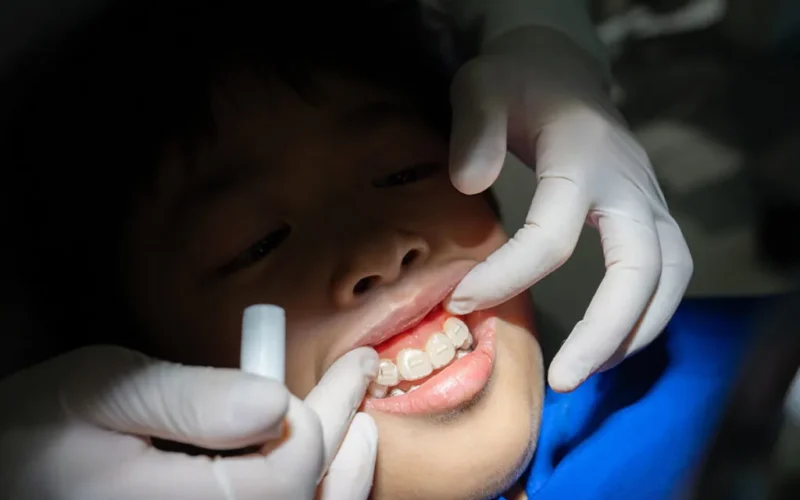 invisalign-attachment-placement-1024x683