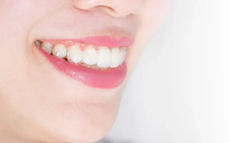 invisalign-being-noticeable-1024x683