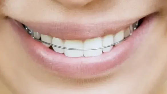 The Importance of Wearing a Retainer