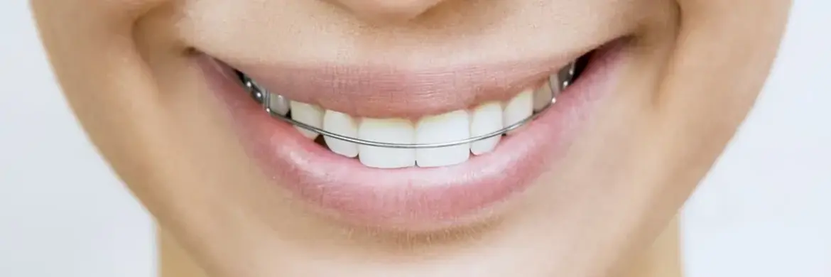 The Importance of Wearing a Retainer