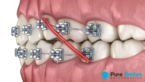 Will I Need Rubber Bands with My Braces?