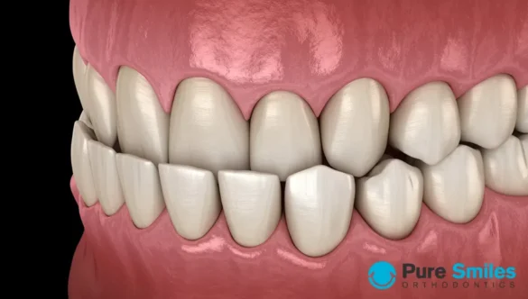 Choosing the Best Orthodontic Treatment for an Underbite