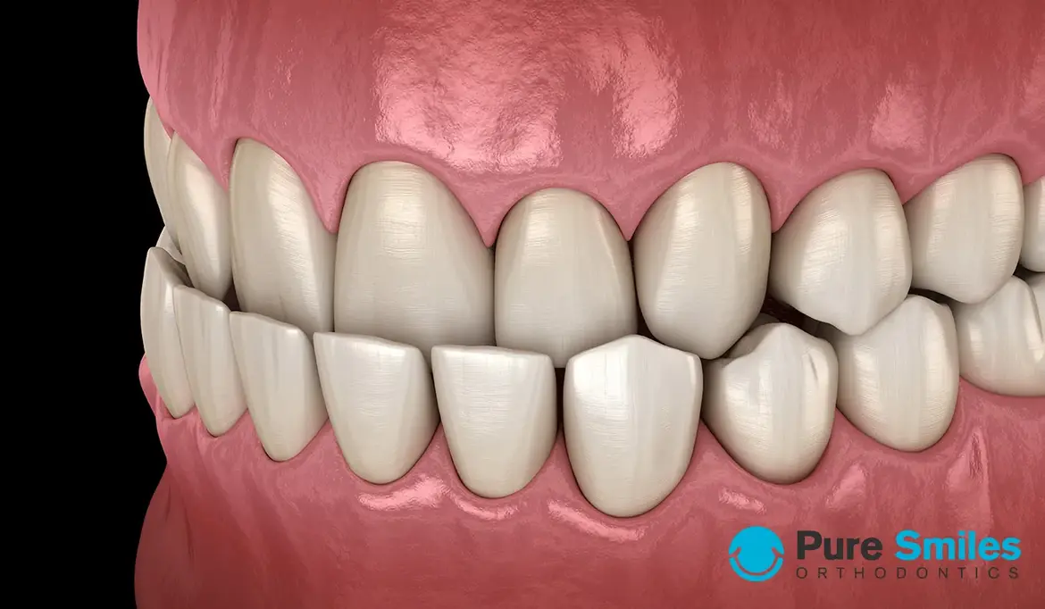 Choosing the Best Orthodontic Treatment for an Underbite
