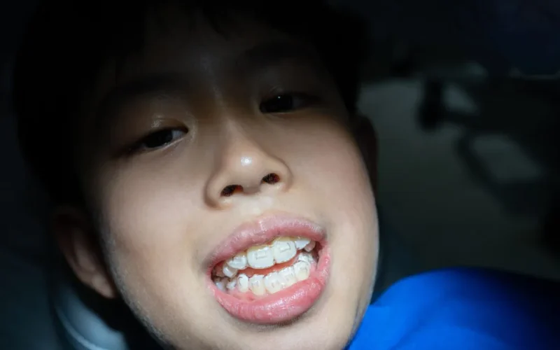 wearing-the-aligners-1024x683