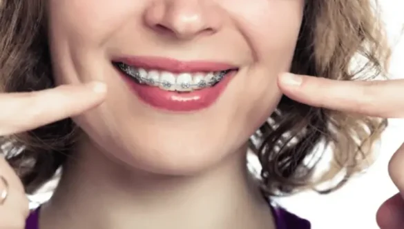5 Reasons Adult Braces Are Worth It