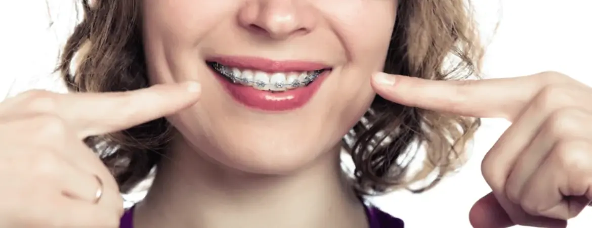 5 Reasons Adult Braces Are Worth It